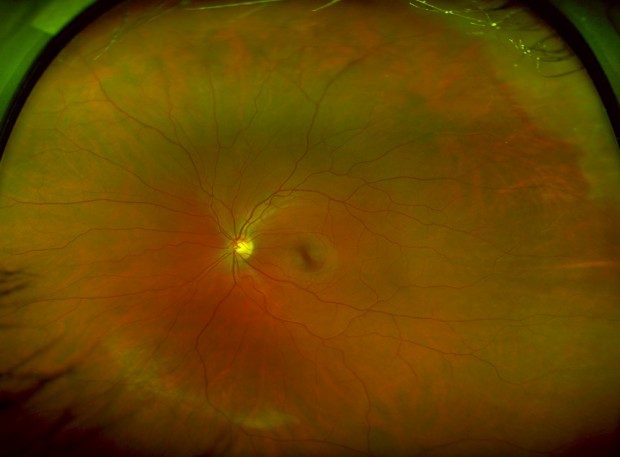 retina in eye