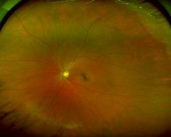 retina in eye